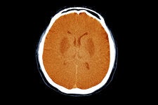 Colored computed-tomography scan of the brain of a 42-year-old patient in a coma with unresponsive pupil dilation. A study suggests that some people might be able to think and remain at least somewhat aware in a vegetative state.